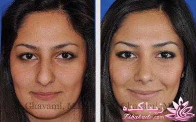 جراحی بینی - جراحی زیبایی